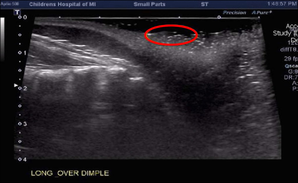 Sacral Dimple Causes, Newborn, Adults, Ultrasound & Management