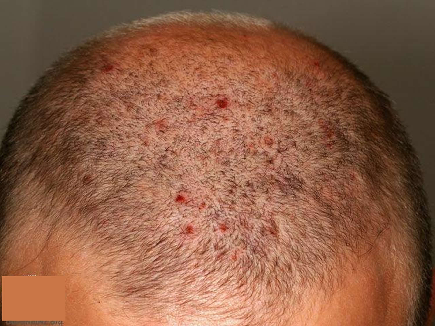 folliculitis scalp