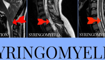 Syringomyelia