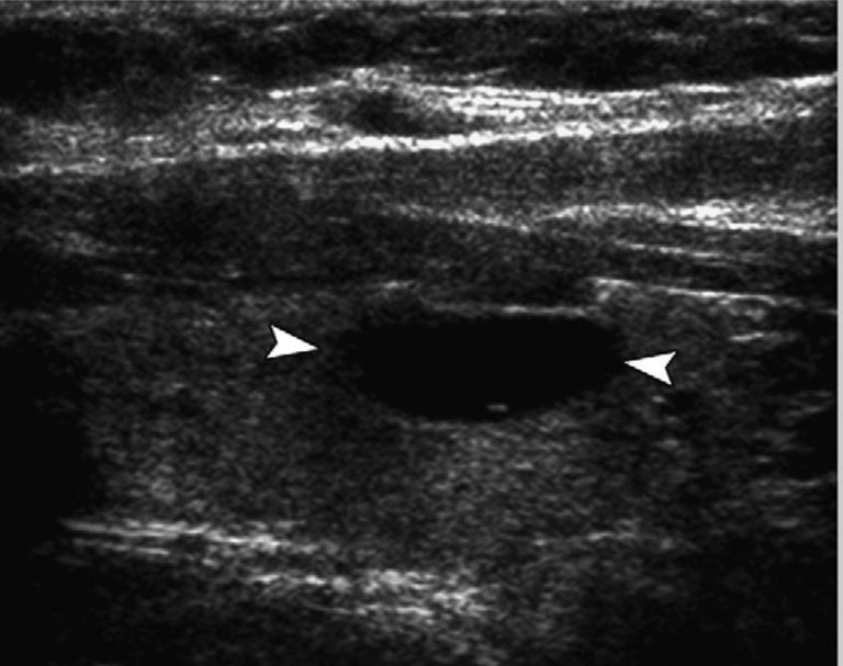 Thyroid Nodules - Causes, Symptoms, Ultrasound, Surgery