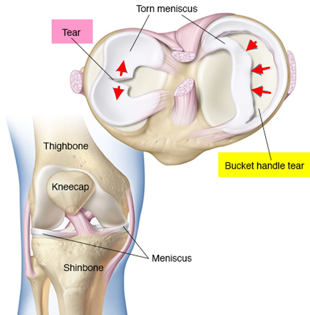 Torn Meniscus Signs And Symptoms Test Diagnosis Recovery Treatment