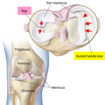 Torn meniscus