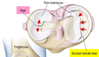 Torn meniscus