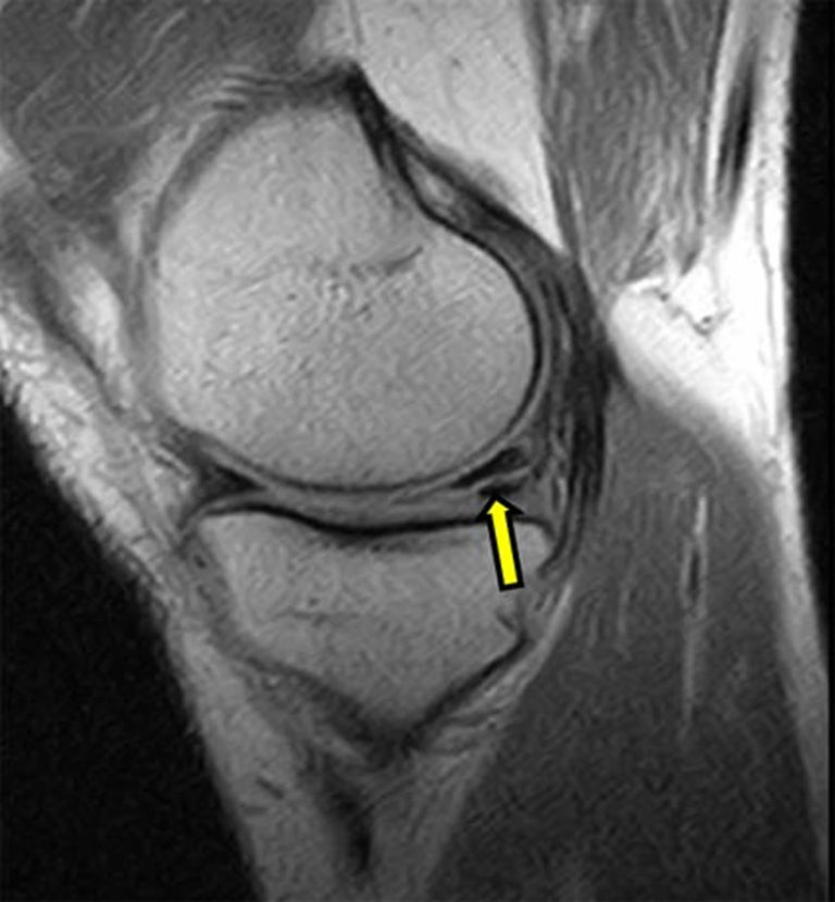 Torn Meniscus - Signs & Symptoms, Test, Diagnosis, Recovery, Treatment