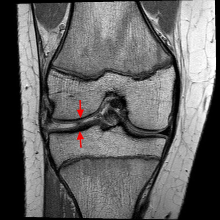 Torn Meniscus Diagnosis