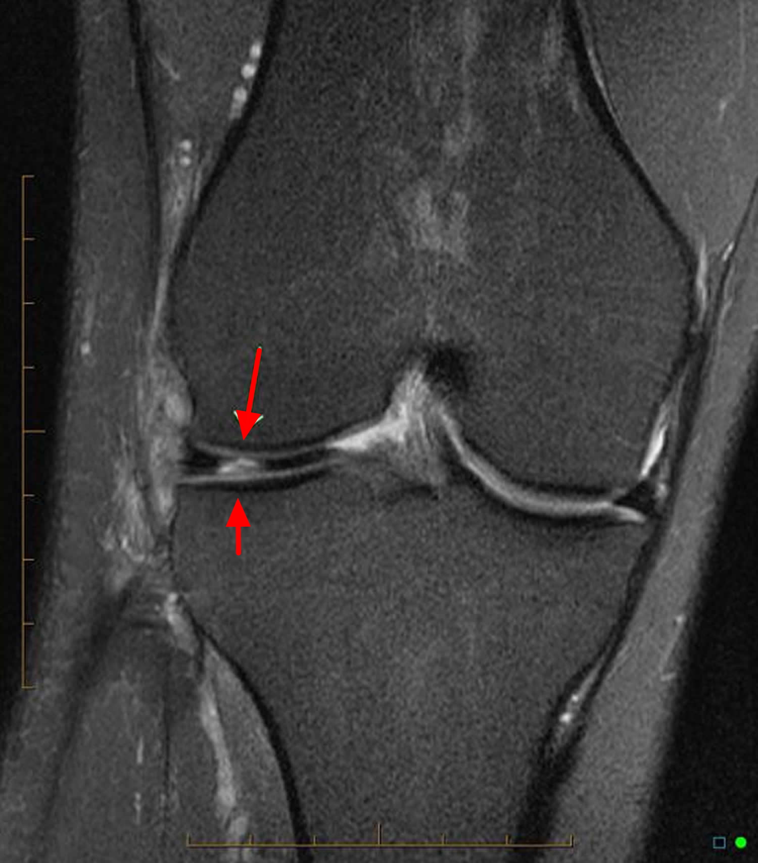 List 91+ Pictures what does a torn meniscus look like on x ray Updated