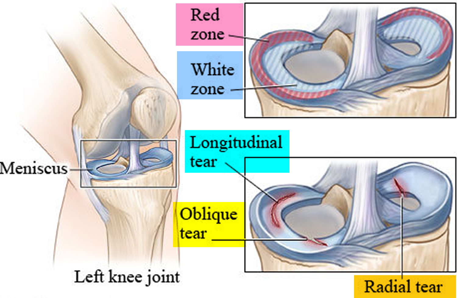 Torn Meniscus Signs And Symptoms Test Diagnosis Recovery Treatment 8347