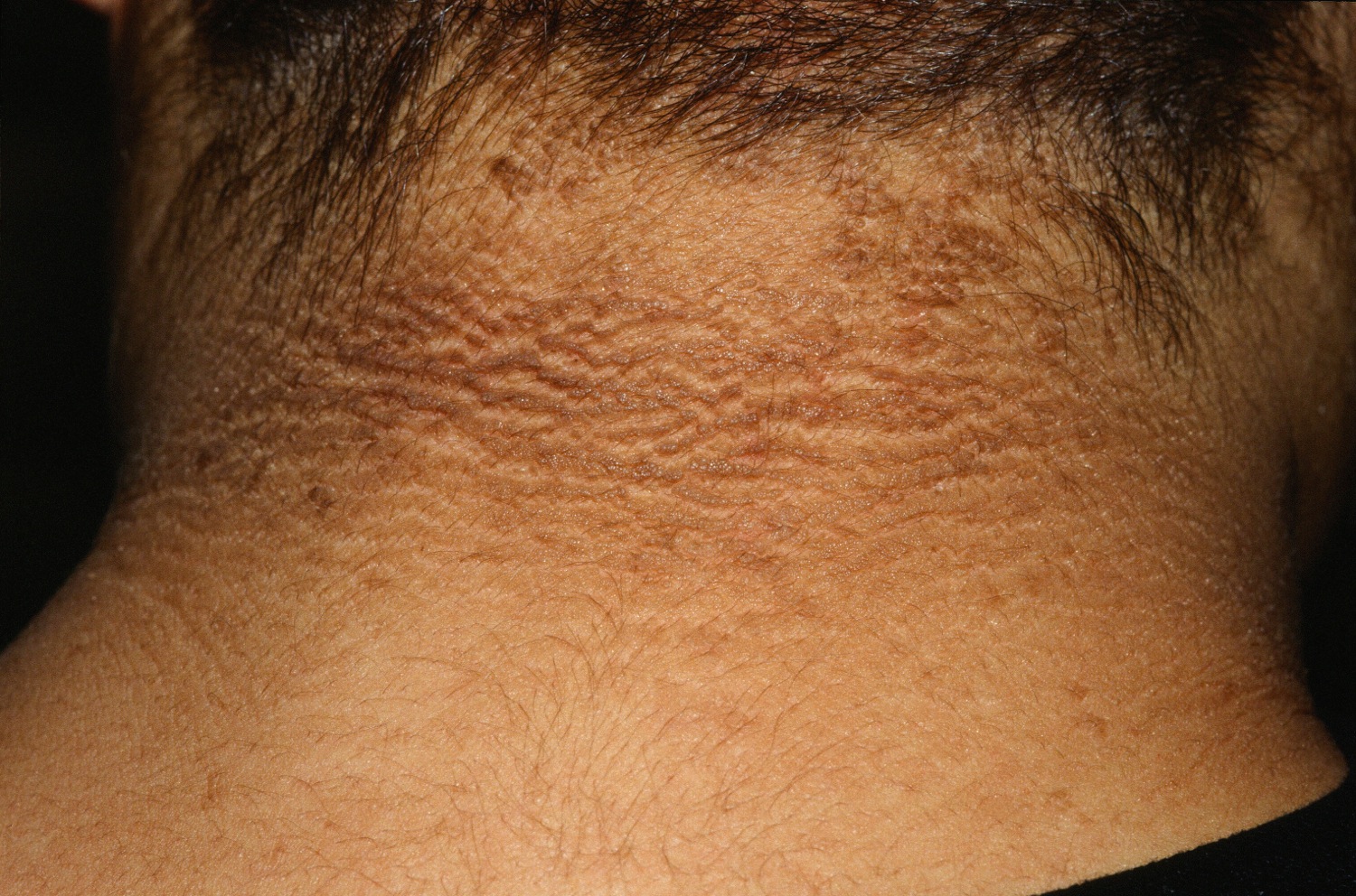 Acanthosis Nigricans - Causes, Symptoms, Treatment