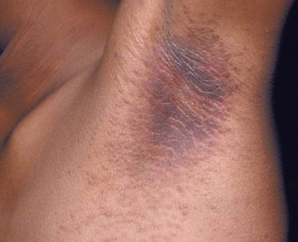 Acanthosis Nigricans Causes, Symptoms, Treatment