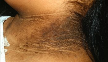 acanthosis nigricans neck