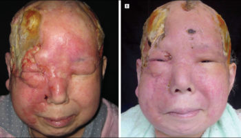 angiosarcoma