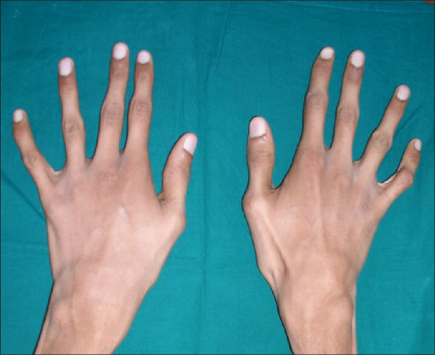 Изменение формы руки. Синдром Марфана (арахнодактилия). Арахнодактилия симптомы. Арахнодактилия паучьи пальцы.