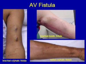 Arteriovenous Fistula - For Dialysis, Dural, Symptoms
