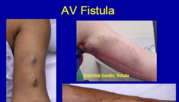 arteriovenous fistula