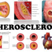 atherosclerosis