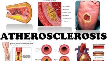 atherosclerosis