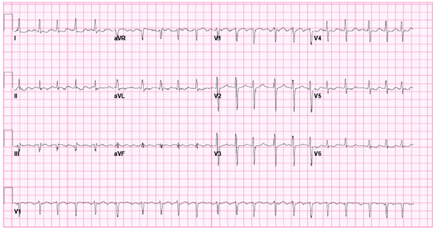 atrial flutter causes during pregnancy