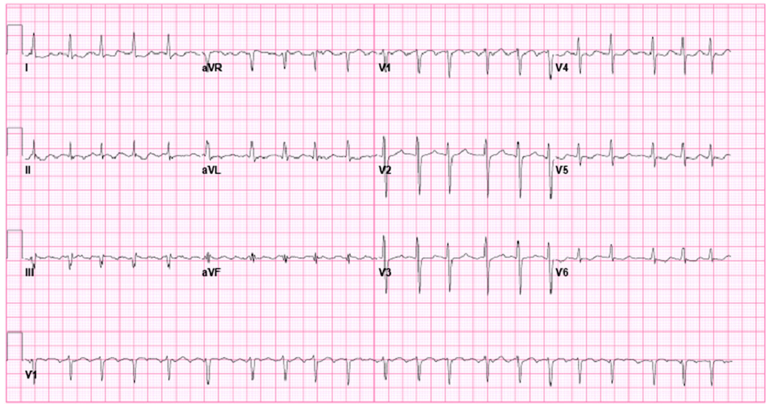 Atrial Flutter Ablation Lulicali
