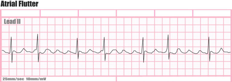 heart ablation for a flutter