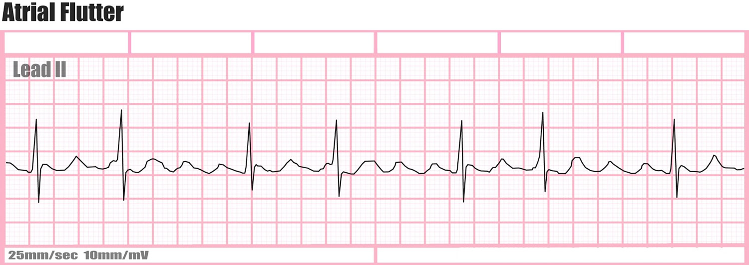 atrial flutter causes definition
