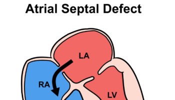atrial septal defect