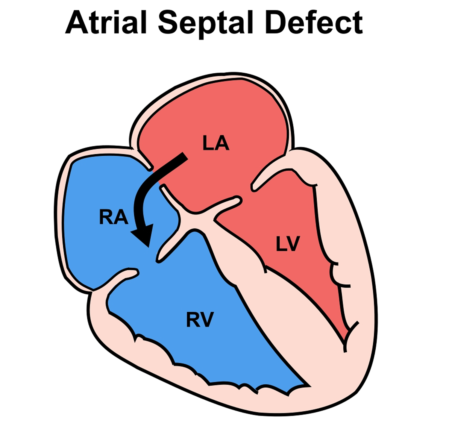 Atrial Septal Defect - Causes, Symptoms, Types, Diagnosis, Treatment