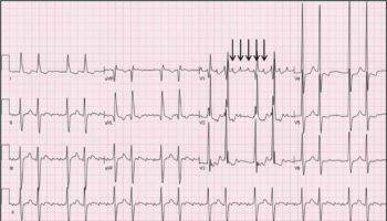 atrial tachycardia