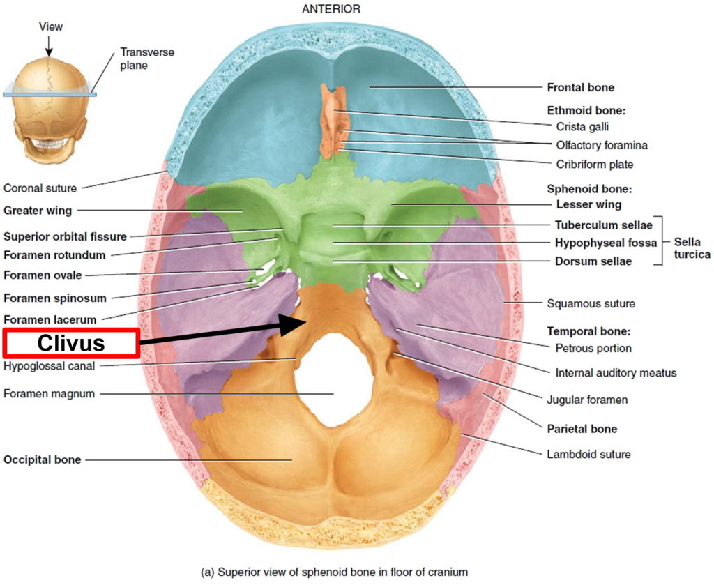 Chordoma Cancer - Causes, Symptoms, Life Expectancy, Treatment