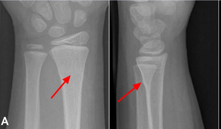 buckle fracture wrist 2 year old