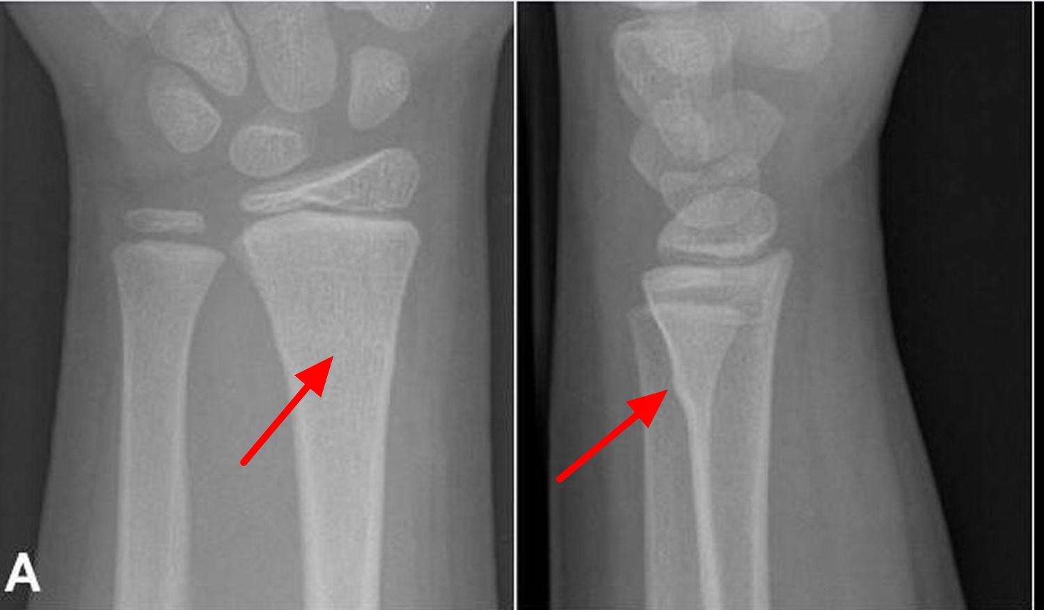 Fracture - Causes, Healing Time, Treatment