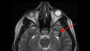 cerebral cavernous malformation