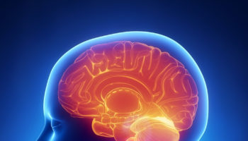 chiari-malformation