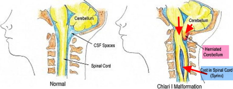 Chiari Malformation - Causes, Symptoms, Prognosis, Diagnosis, Treatment