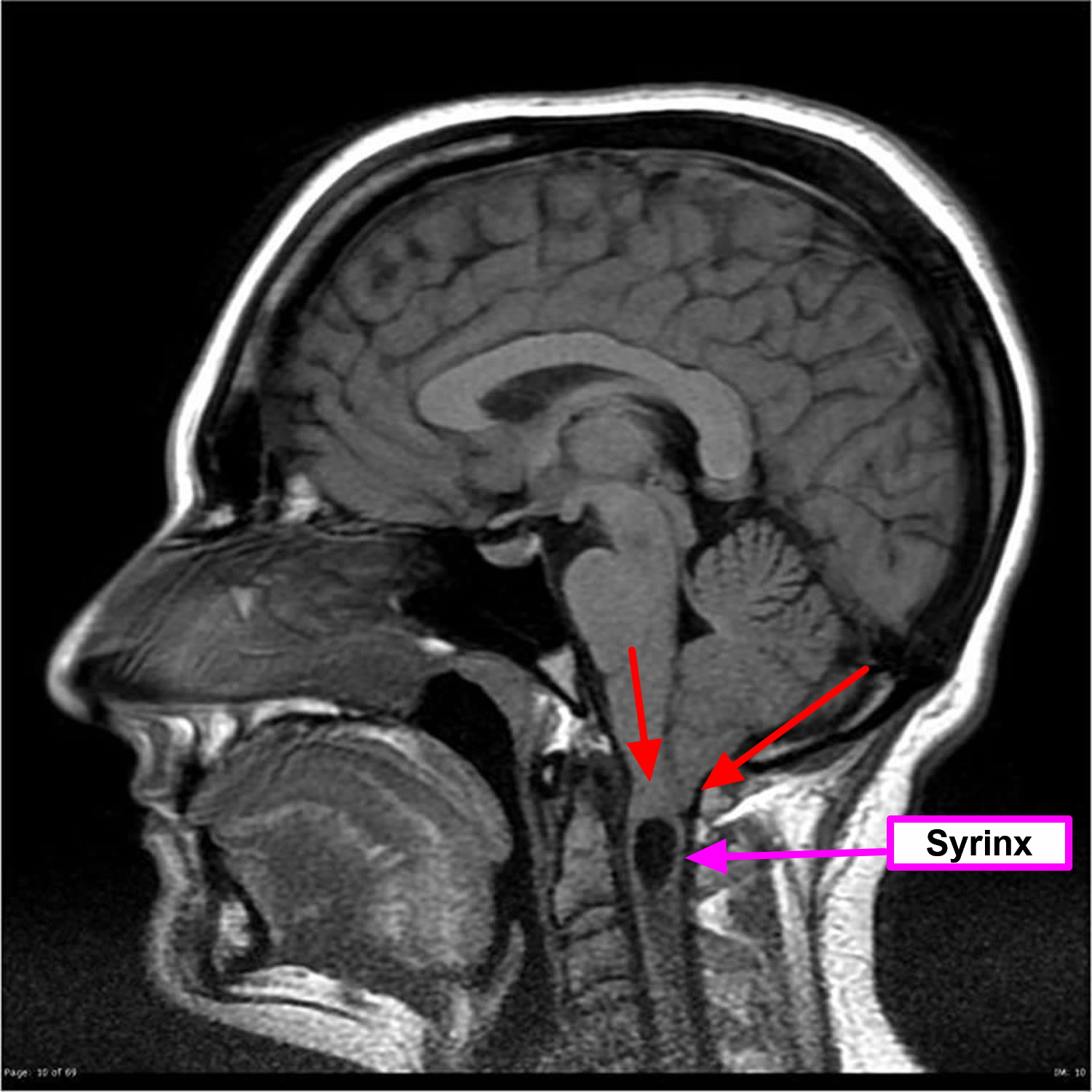 chiari malformation type 1 with syrinx