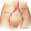 claudication