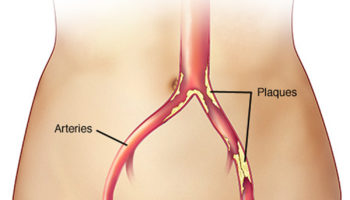 claudication