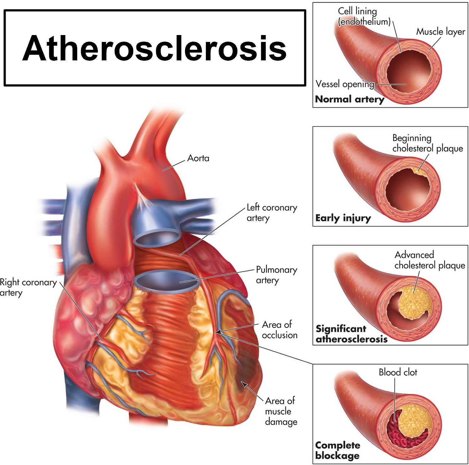 Atherosclerosis Causes, Risk Factors, Symptoms, Diagnosis & Treatment