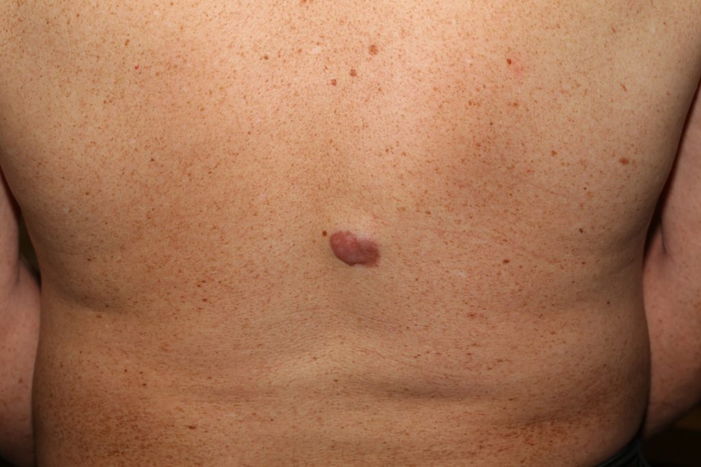 Dermatofibrosarcoma Protuberans - Causes, Staging, Treatment