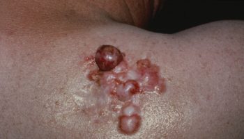 dermatofibrosarcoma protuberans