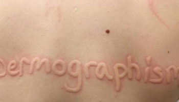 dermatographia