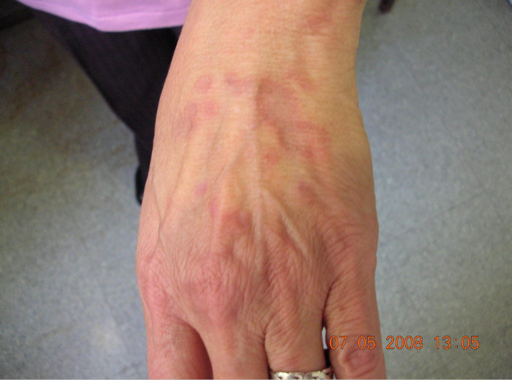 Granuloma Annulare Causes, Rash, Treatment