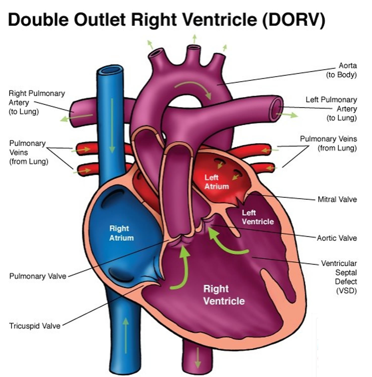 Double Outlet Right Ventricle - Repair, Surgery & Survival ...