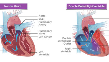 double outlet right ventricle
