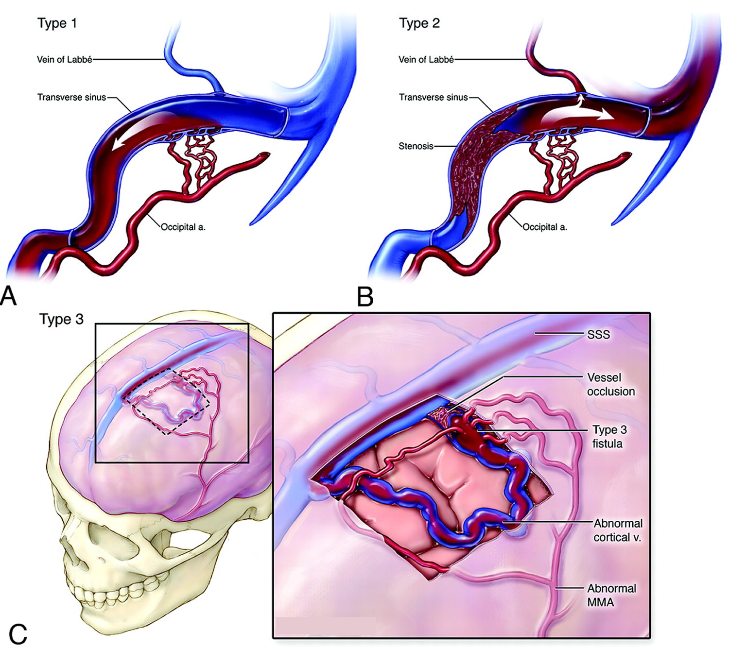 Arteriovenous Fistula For Dialysis Dural Symptoms 1528