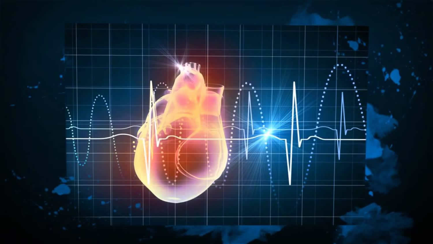 Is An Ectopic Heartbeat The Same As An Irregular Heartbeat