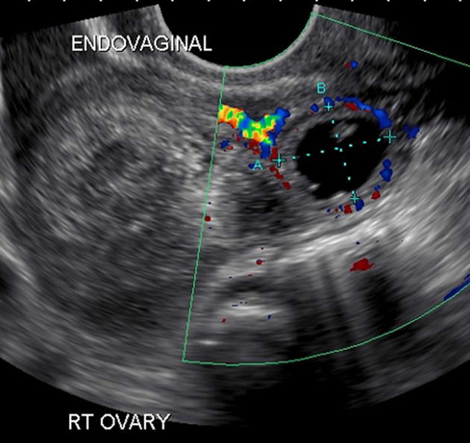 Тянет яичник при беременности на ранних. Внематочная беременность на УЗИ. Внематочная Трубная беременность УЗИ. УЗИ интерстициальной внематочной беременности. Внематочная беременность в трубе УЗИ.