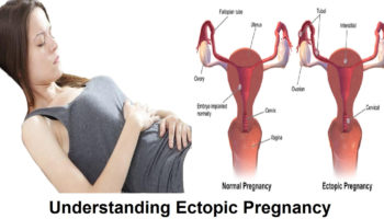 ectopic pregnancy