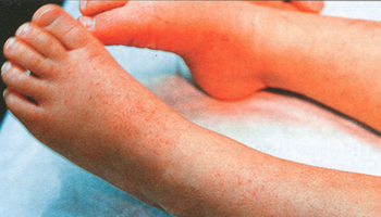 ehrlichiosis