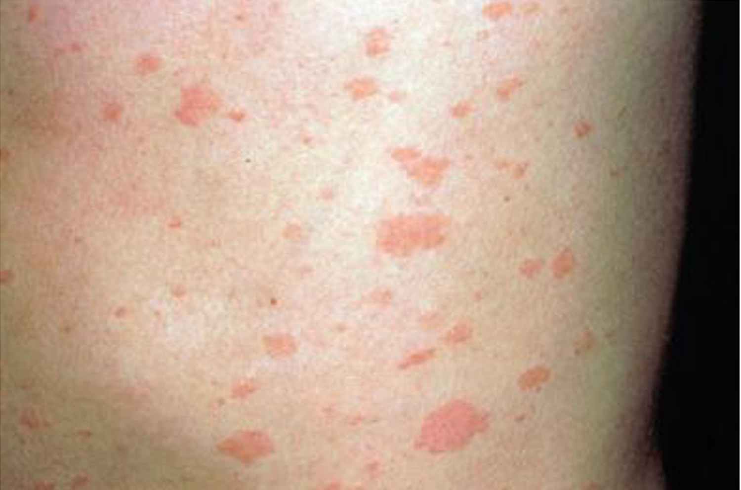 syphilis-rash-on-stomach