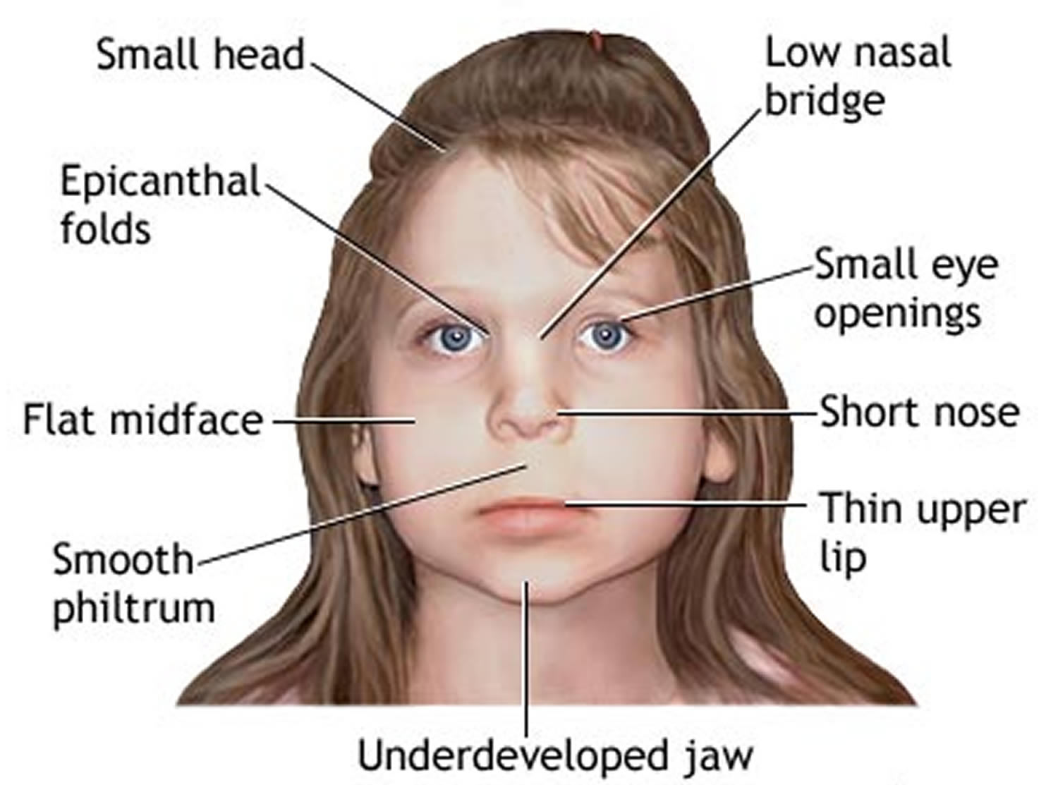 case study fetal alcohol syndrome